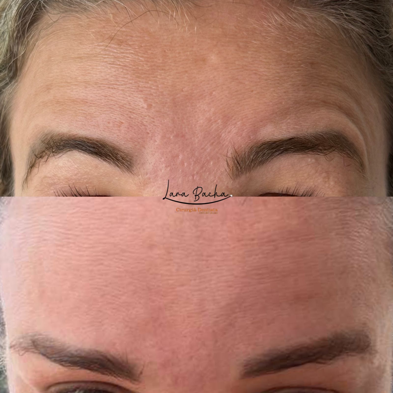 Botox e harmonização facial – antes e depois