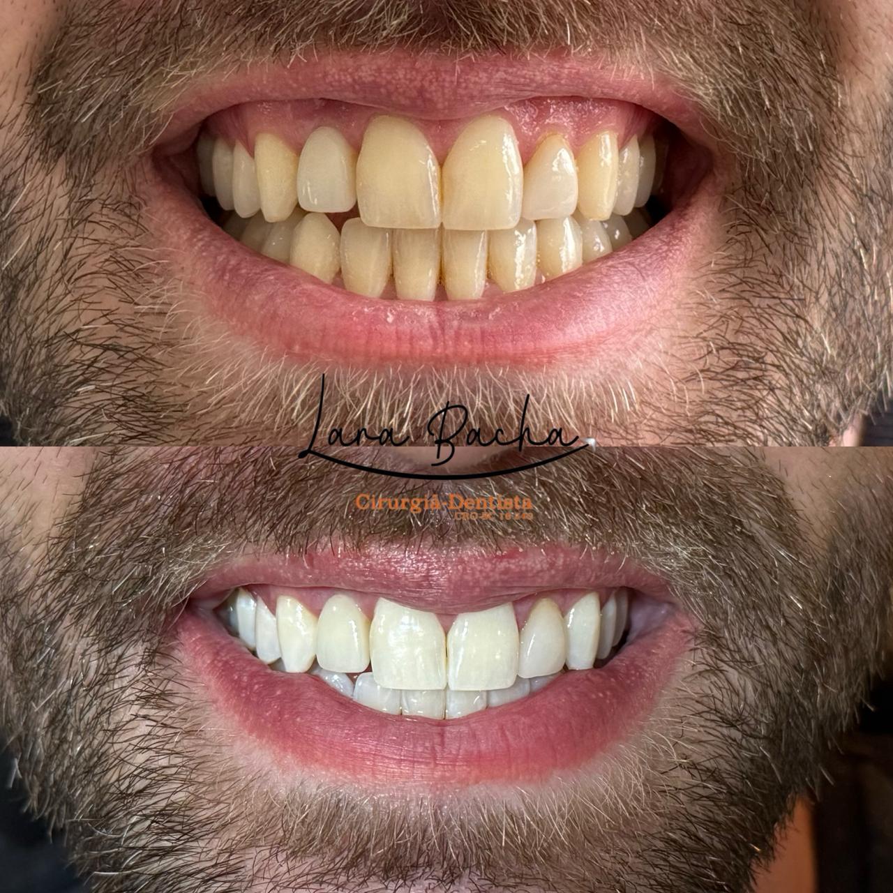 Clareamento dental – antes e depois