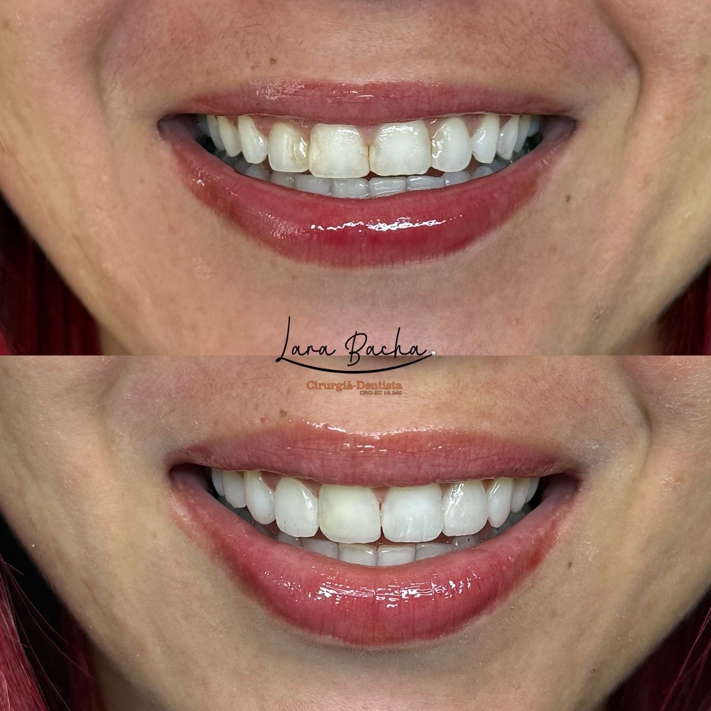 Facetas dentárias – antes e depois, transformação completa do sorriso