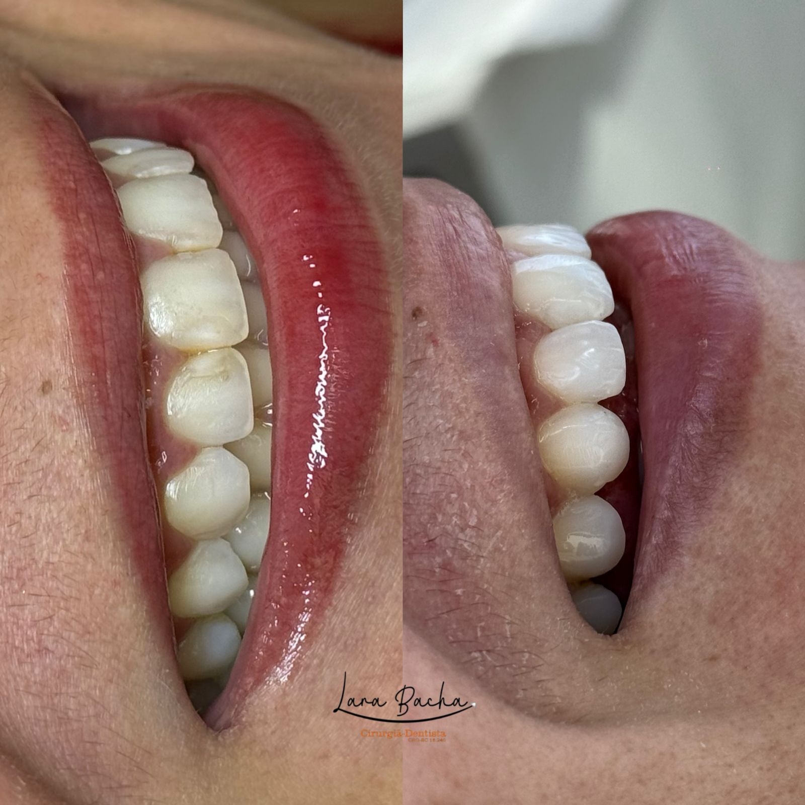 Facetas dentárias – antes e depois, harmonia e naturalidade