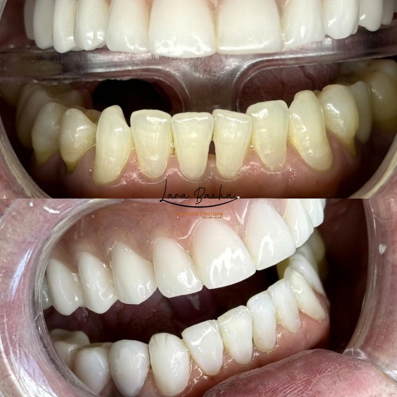 Facetas dentárias – antes e depois